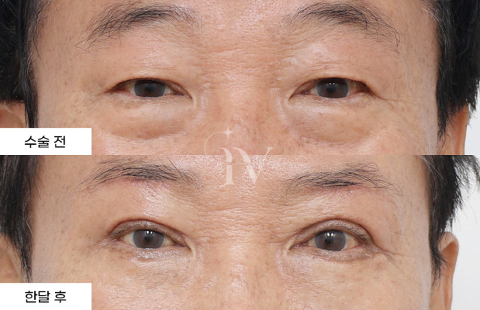 눈썹하거상술, 상안검, 하안검