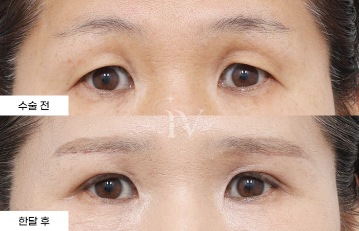 눈썹하거상, 매몰쌍꺼풀