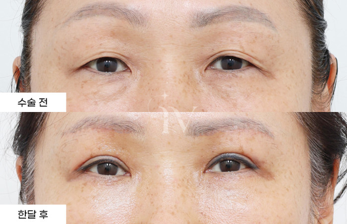 눈썹하거상술, 상안검, 하안검