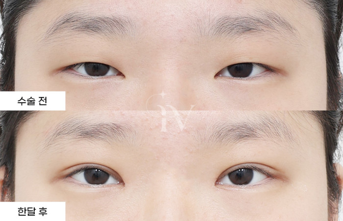 절개쌍꺼풀, 앞트임, 눈매교정