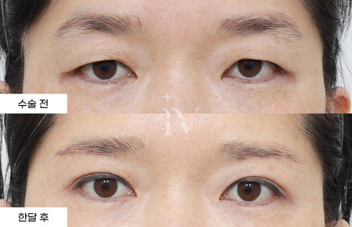 눈썹하거상술, 매몰