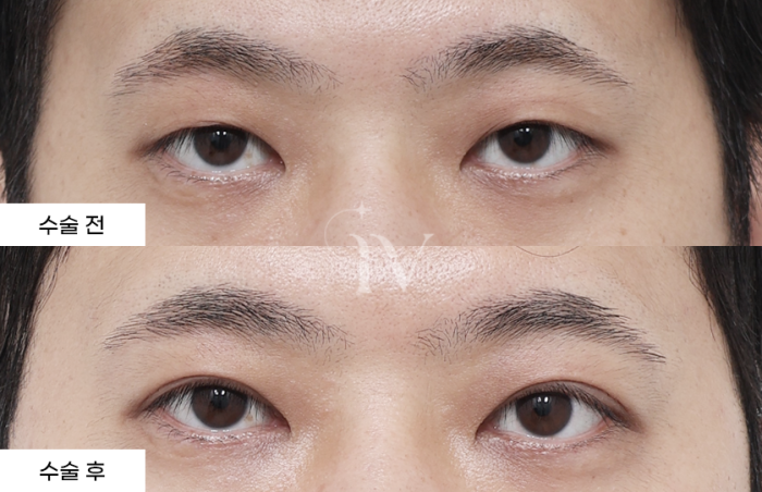 절개, 눈매교정