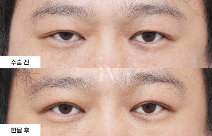 절개 쌍꺼풀, 눈매교정