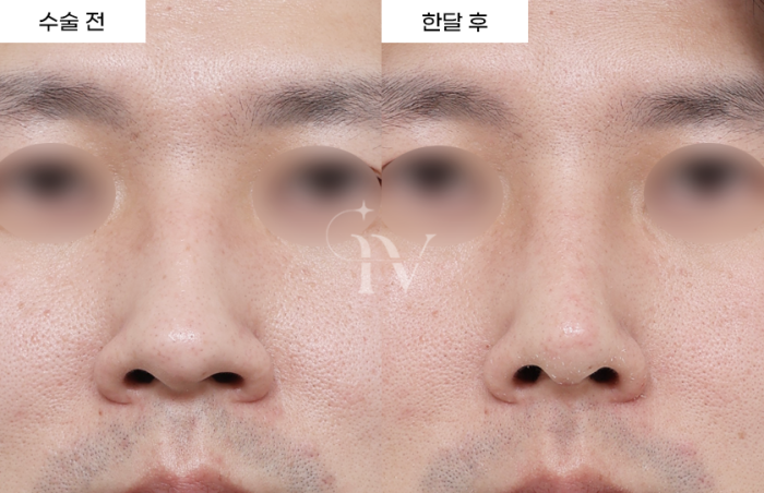 콧대, 코끝