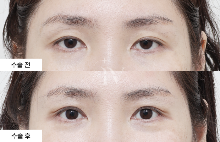 절개 쌍꺼풀, 눈매교정, 눈위나노지방이식 (타병원 눈재수술)