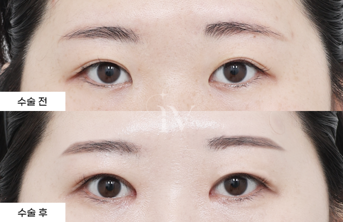 절개쌍꺼풀, 앞트임 (타병원 눈재수술)