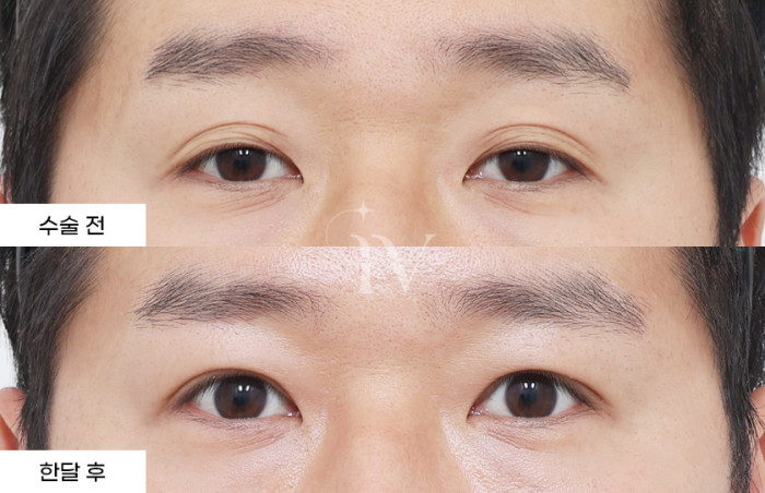 절개쌍꺼풀, 눈매교정