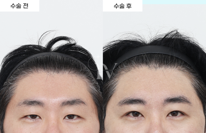 내시경이마거상, 상안검