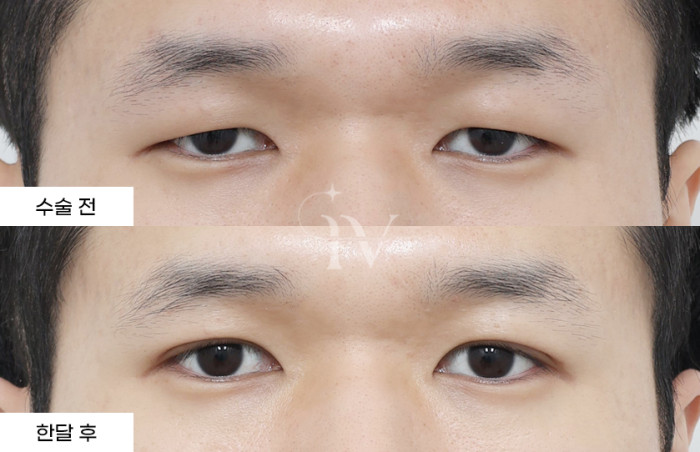 절개 눈성형