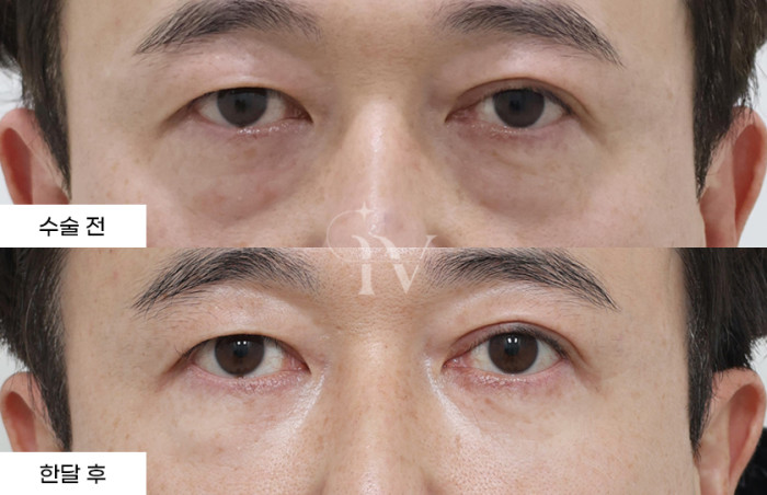 눈밑지방재배치, 눈밑나노지방이식