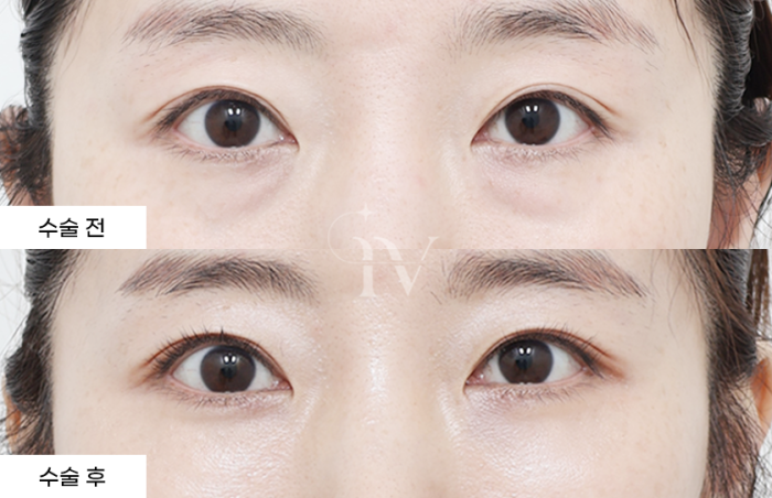 눈밑지방재배치