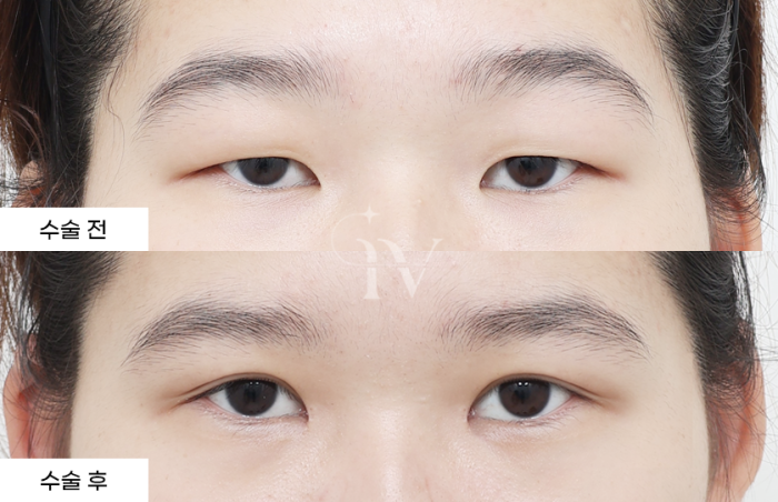 절개 쌍꺼풀, 눈매교정, 앞트임