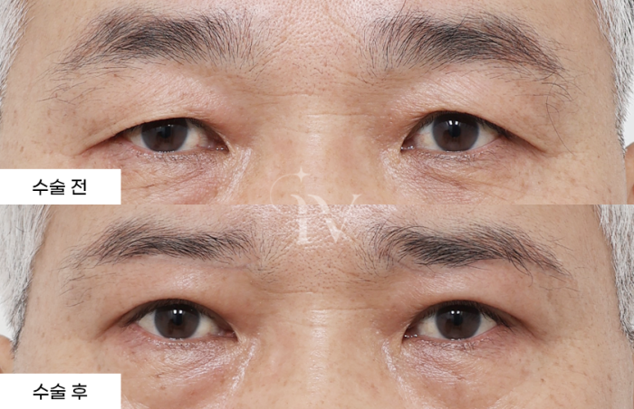 눈썹하거상, 매몰 쌍꺼풀
