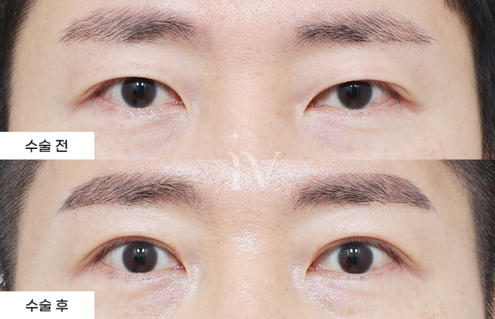 절개 쌍꺼풀, 눈매교정, 윗트임