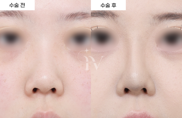 콧대, 코끝, 기증늑