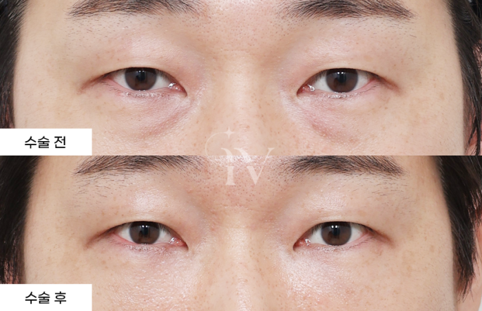 눈밑지방재배치, 나노지방이식