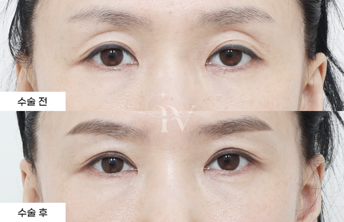 상안검, 눈매교정, 나노지방이식
