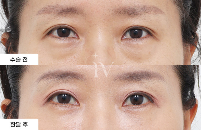 눈밑지방재배치, 눈밑나노지방이식