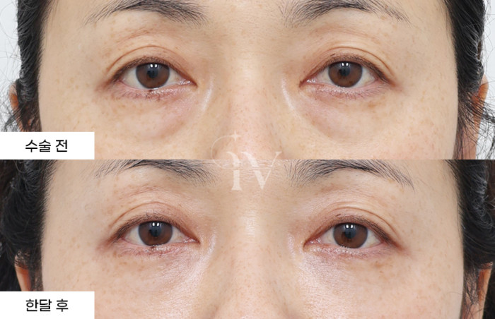 눈밑지방재배치, 눈밑나노지방이식