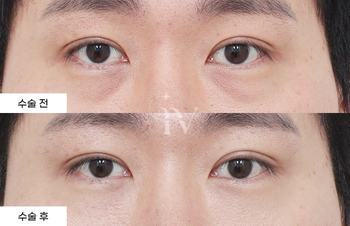 눈밑지방재배치