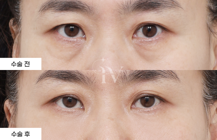 눈밑지방재배치, 나노지방이식