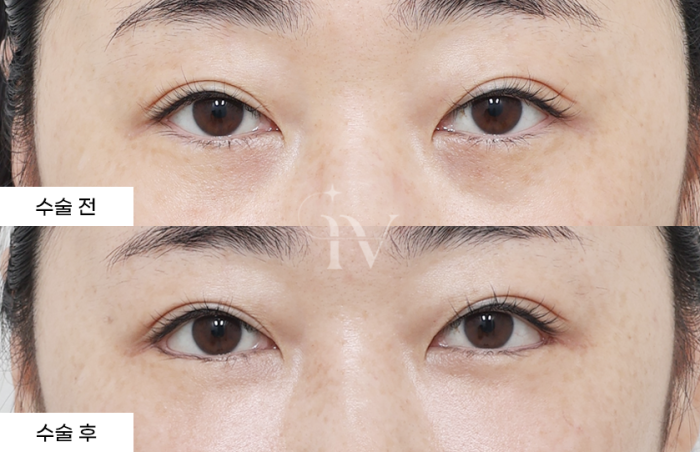 밑트임, 뒷트림, 눈밑지방재배치 나노지방이식