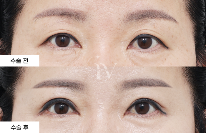 상안검, 뒤/밑트임