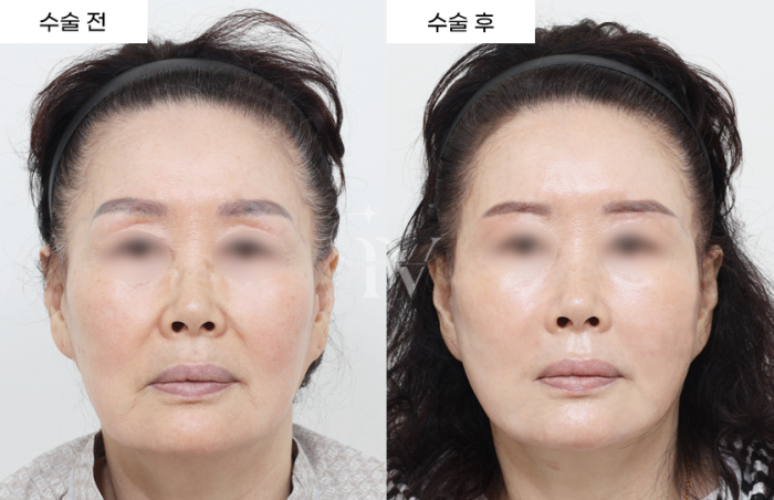 눈썹하거상, 안면거상