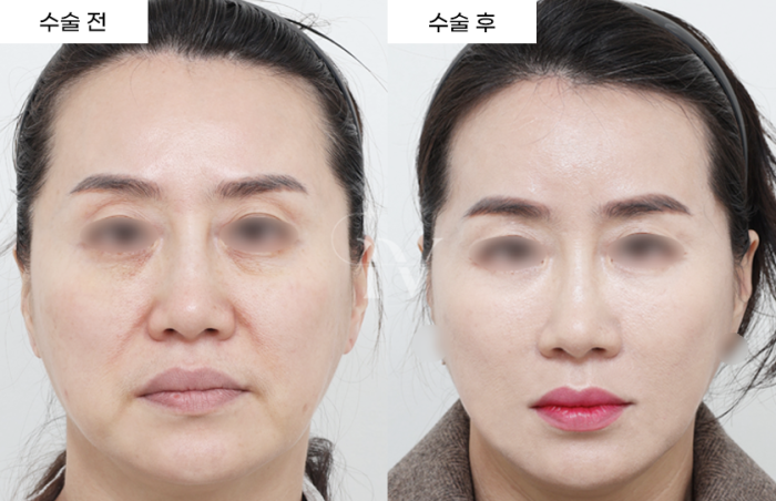 얼굴 전체 지방이식