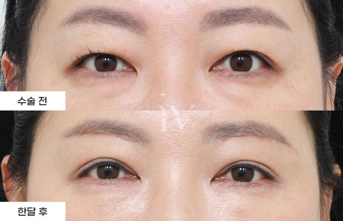 눈썹하거상술, 상안검