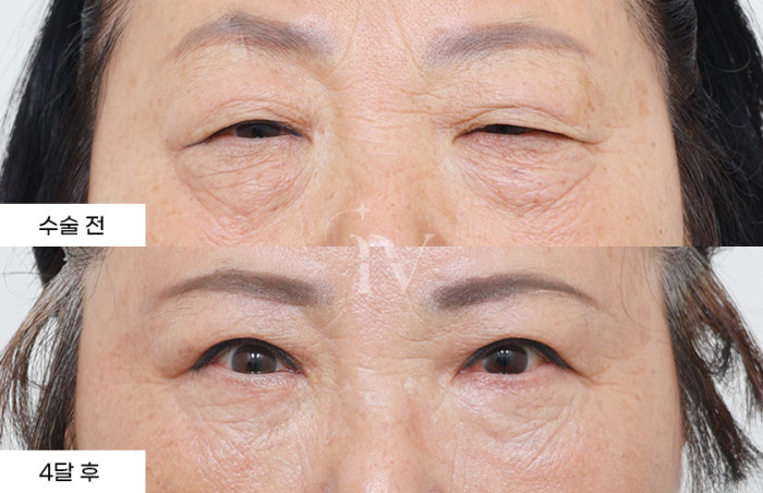 눈썹하거상, 상안검, 하안검