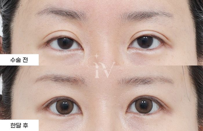절개 쌍꺼풀