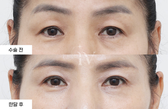 눈썹하거상술, 매몰쌍꺼풀, 눈밑지방재배치, 눈밑나노지방이식