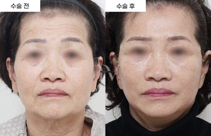 절개이마거상, 안면목거상