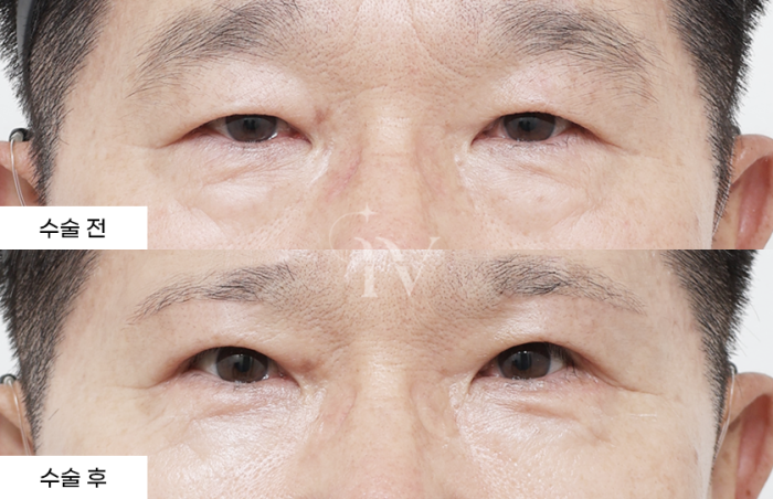 눈썹하거상, 상안검, 하안검, 나노지방이식