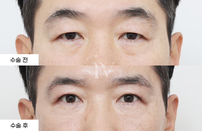 눈썹하거상, 매몰 쌍꺼풀, 하안검, 눈밑나노지방이식