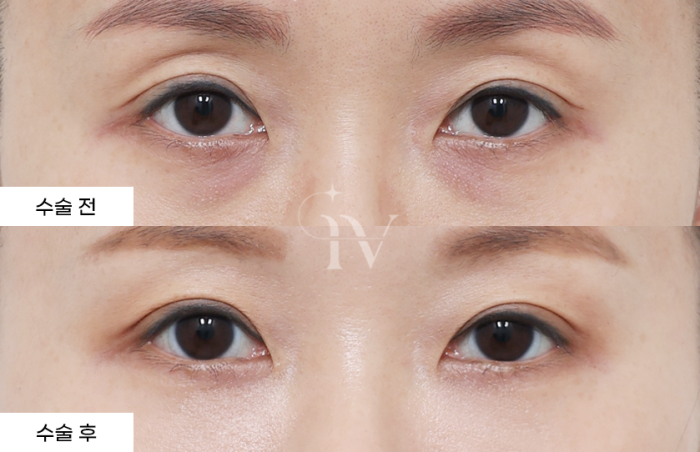 눈밑지방재배치, 나노지방이식, 눈위지방이식