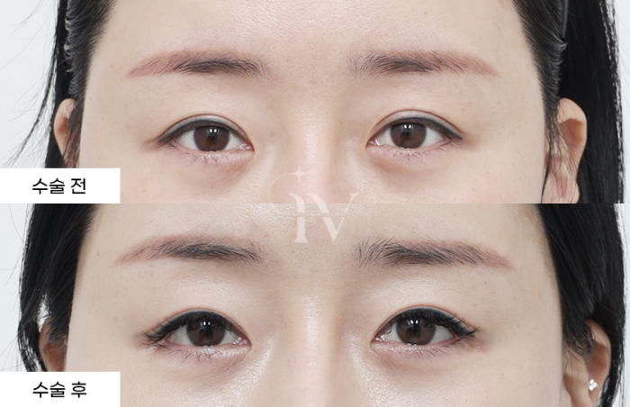 절개쌍꺼풀, 눈매교정, 튀/밑트임 (타병원 눈재수술)