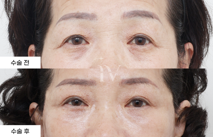 눈썹하거상, 하안검