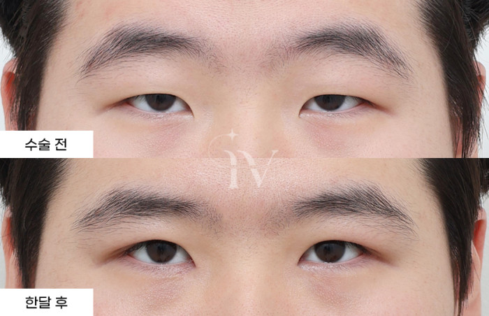 절개 쌍꺼풀, 눈매교정, 앞트임