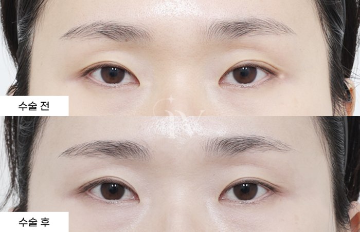 절개쌍꺼풀 (타병원 눈재수술)